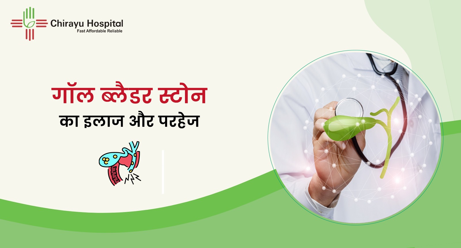 Gallbladder stone treatment